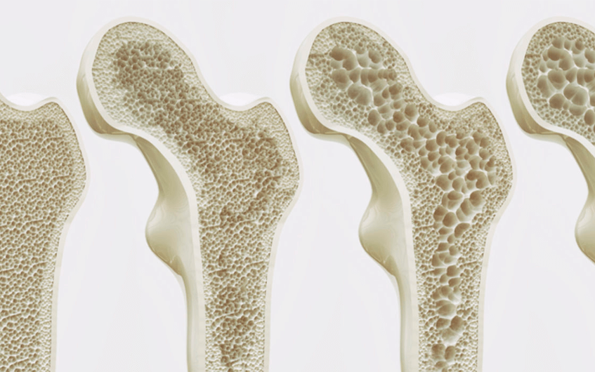 Efeitos da osteoporose nos ossos